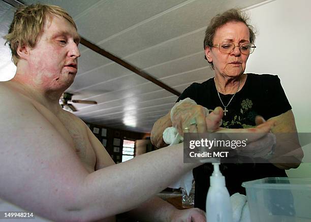 David Hoffman's skin grafts are cleaned and moisturized by Judy Harris on Saturday, August 4 in Port Orchard, Washington. Harris works for multiple...