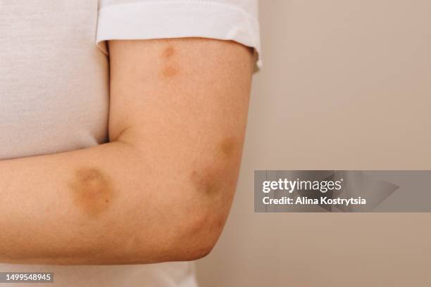 bruises or hematomas on a woman's arm - prellung stock-fotos und bilder