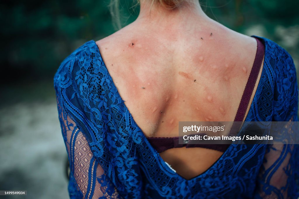 Mosquito bites the back of a girl