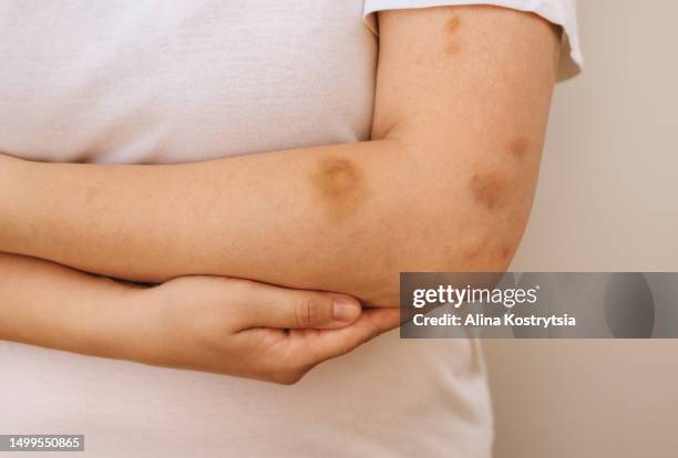 bruises or hematomas on woman's arm after an accident - ellenbogen stock-fotos und bilder