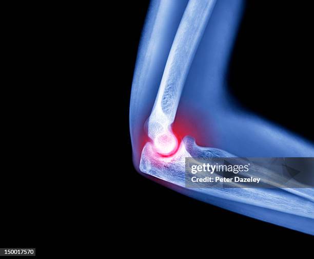 x-ray of 'tennis elbow' ailment - joint pain stock pictures, royalty-free photos & images