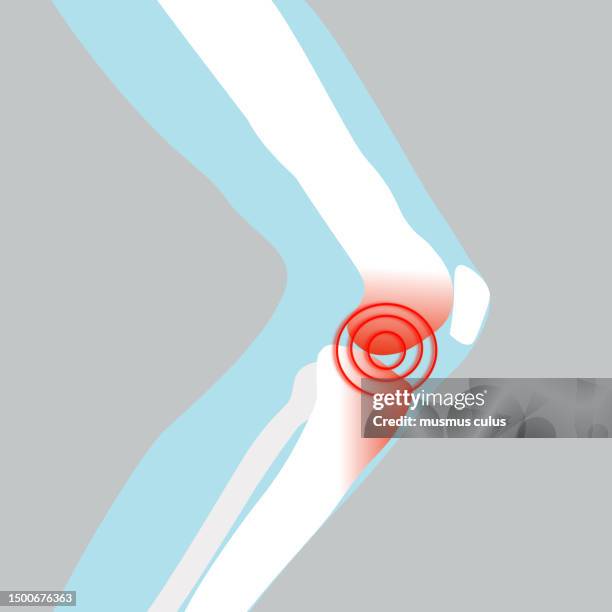 damage to the human knee. meniscus, arthritis - muscle ache stock illustrations