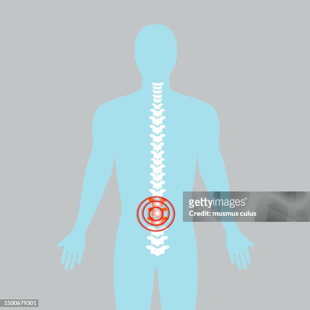 脊椎の損傷、椎間板ヘルニア。 腰痛 - カイロプラクター点のイラスト素材／クリップアート素材／マンガ素材／アイコン素材