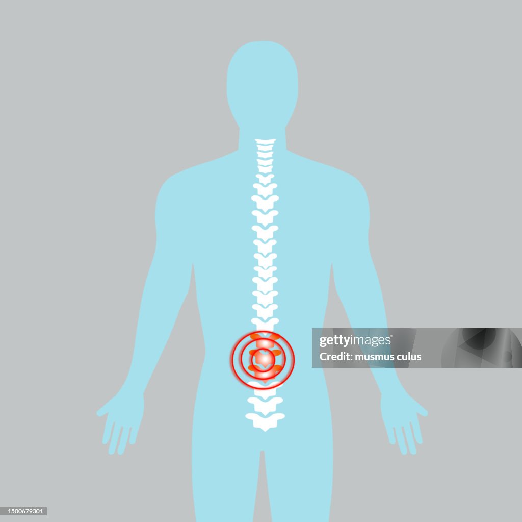 Damage to the spine, herniated disc. backache