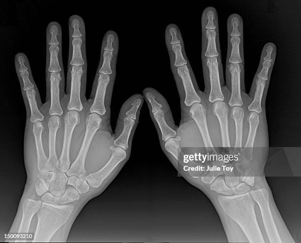 Normal Full Hand Normal Hand X Ray