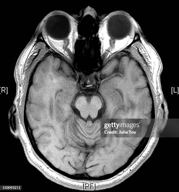 mri brain / head - eye scan stock-fotos und bilder