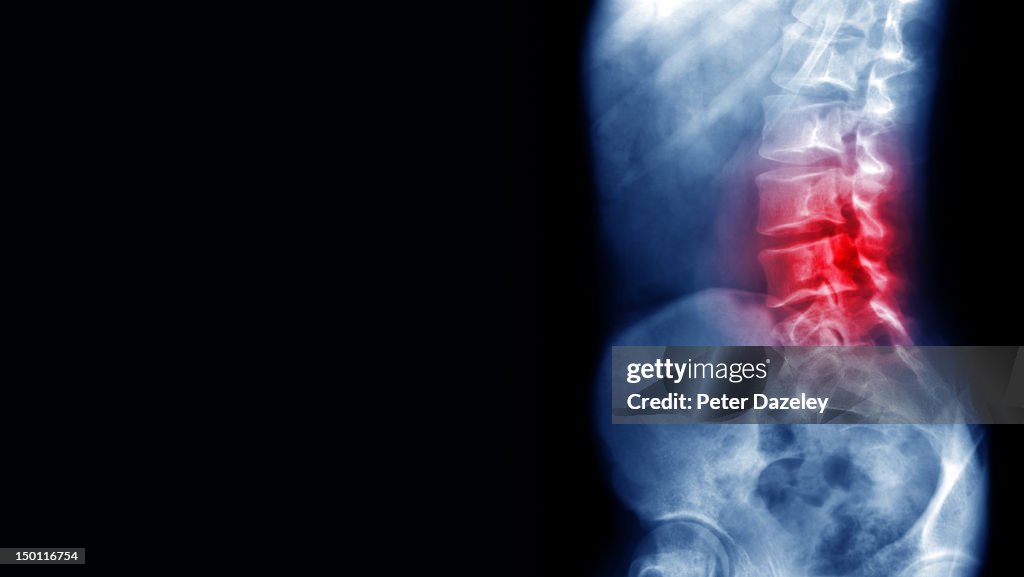 Back pain x-ray