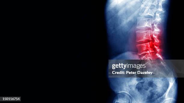 back pain x-ray - herniated disc 個照片及圖片檔