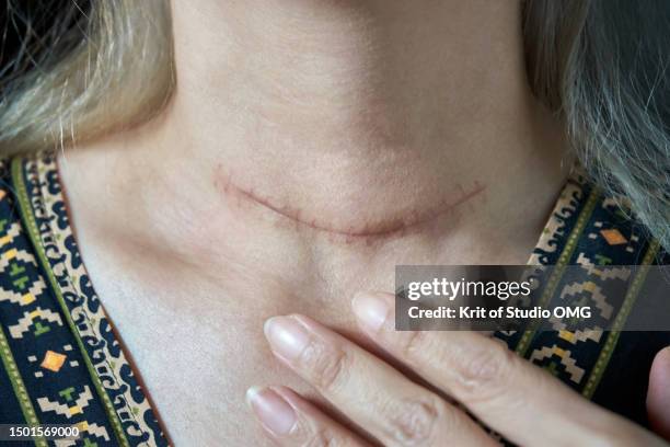 a woman's neck wound after thyroid nodule surgery - glándula de tiroides fotografías e imágenes de stock
