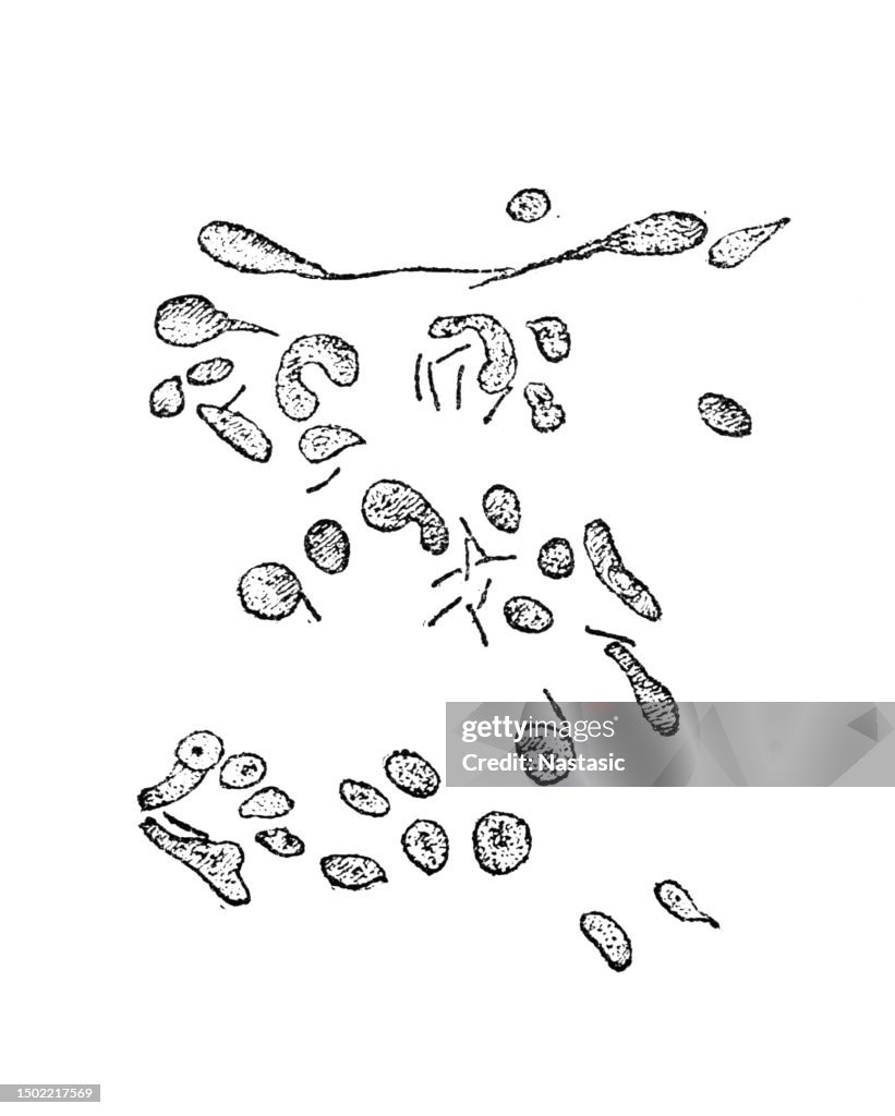Tuberculosis sputum