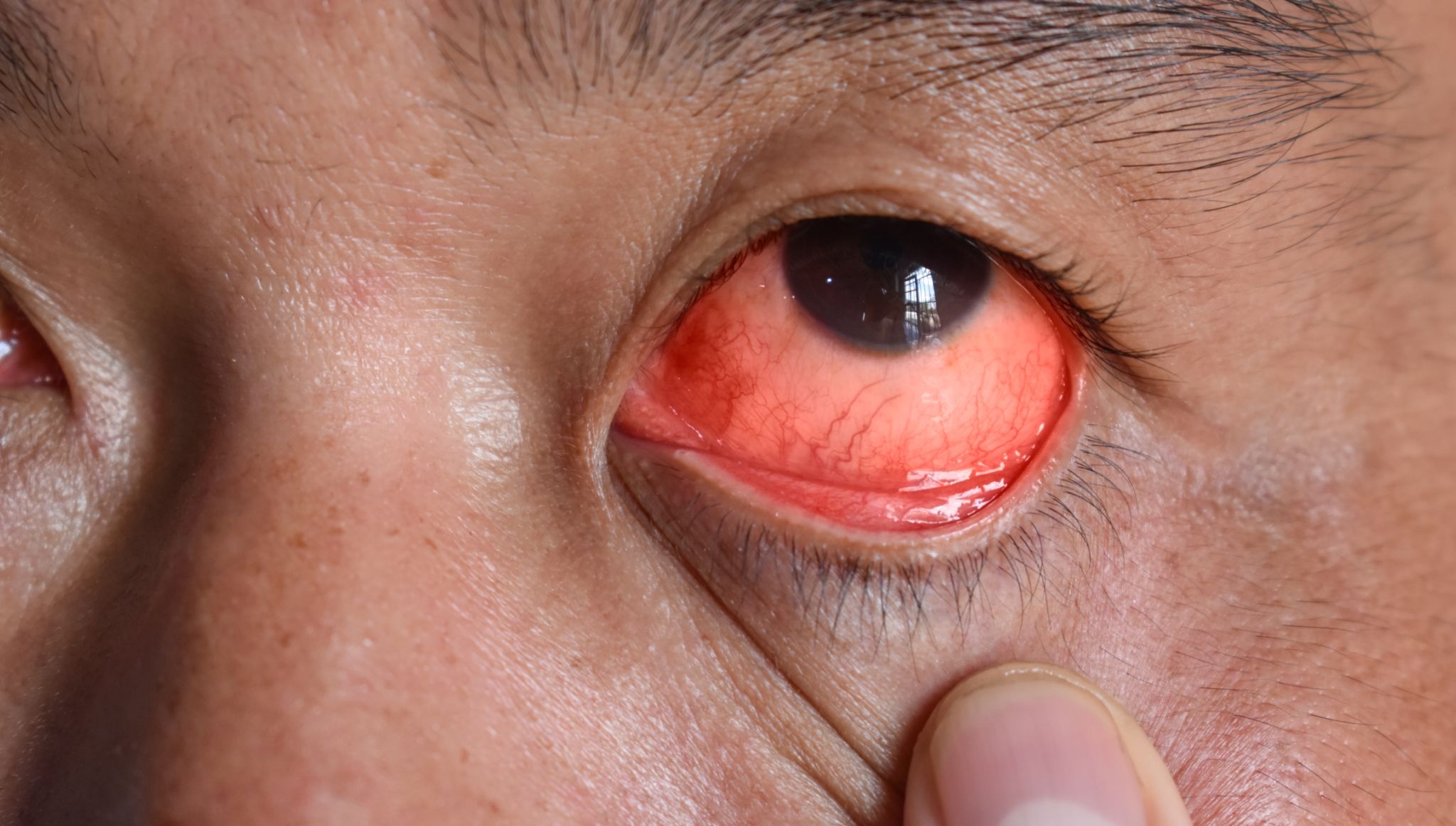 Corneal infection or ulcer called keratitis in Asian man. Corneal infection or ulcer called keratitis in Asian man.