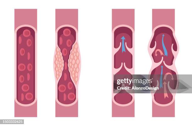 normale arterie und cholesterin blockierte arterie. verstopfte arterien durch cholesterin. normale venen und krampfadern. - krampfader stock-grafiken, -clipart, -cartoons und -symbole