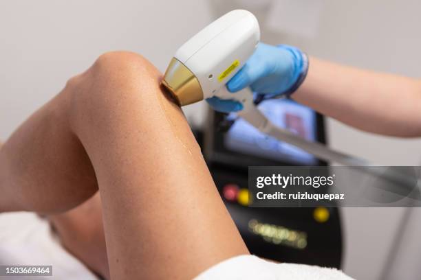 leg laser hair removal process - laser stockfoto's en -beelden