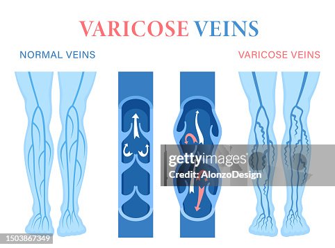 Varicose Veins. Venous Insufficiency And Vascular Disease Concept. Venous Reflux. Varicose Veins. Venous Insufficiency And Vascular Disease Concept. Venous Reflux.