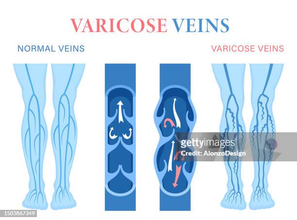 stockillustraties, clipart, cartoons en iconen met varicose veins. venous insufficiency and vascular disease concept. venous reflux. - aderklep