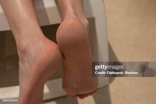 dry feet problem - skin fungal infection stock pictures, royalty-free photos & images
