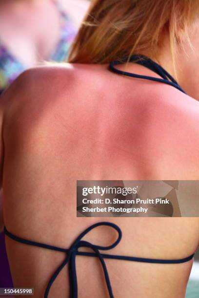 sunburned back and shoulders girl - heat rash stock pictures, royalty-free photos & images