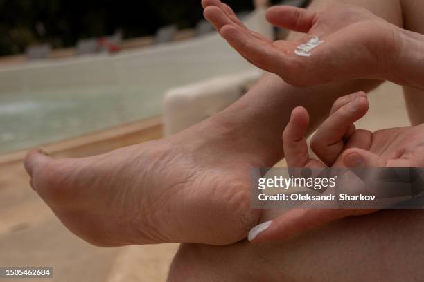 treatment of cracked heels - images of ugly feet stock pictures, royalty-free photos & images