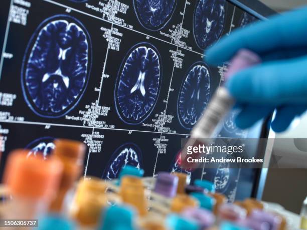 united kingdom, high wycombe, alzheimer's and dementia research, scientist holding a blood sample during a clinical trial with a mri on screen - alzheimers brain stockfoto's en -beelden