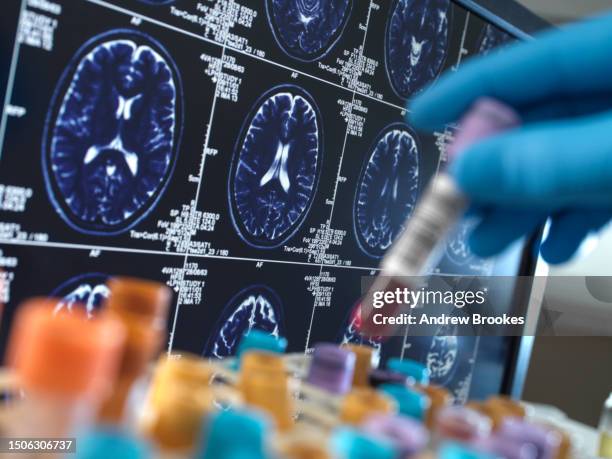 united kingdom, high wycombe, alzheimer's and dementia research, scientist holding a blood sample during a clinical trial with a mri on screen - alzheimer's disease stock pictures, royalty-free photos & images