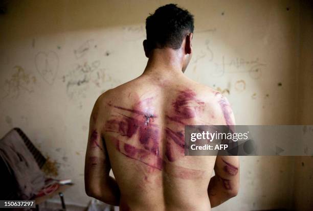 Syrian man shows marks of torture on his back, after he was released from regime forces, in the Bustan Pasha neighbourhood of Syria's northern city...