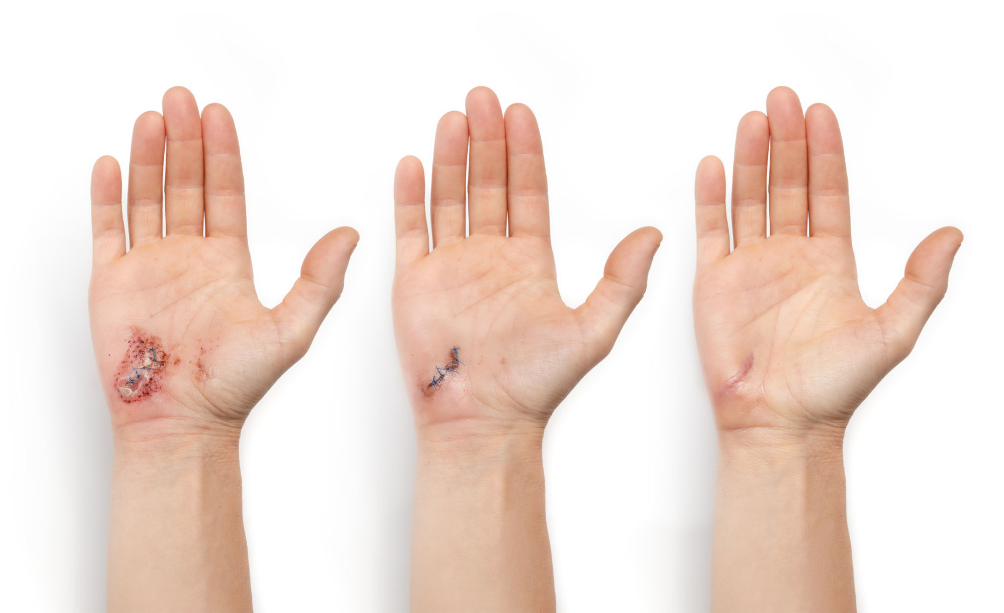 wound healing