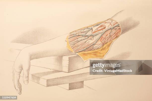 Dissection of the superficial veins and nerves in front of the bend of the elbow is represented in this image, for the purpose of illustrating the...