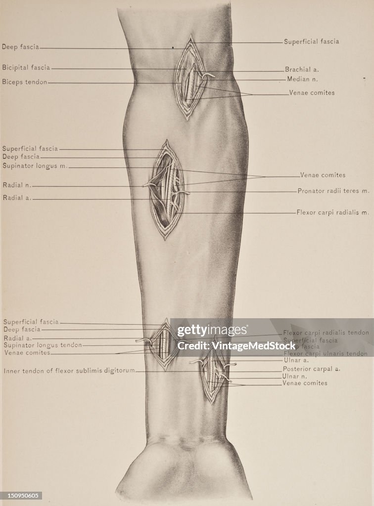 Brachial Artery & Median Nerve At Elbow, Radial Artery & Radial Nerve Of Forearm, Radial Artery In Lower Third Of Forearm, & Ulnar Artery & Nerve Above Wrist