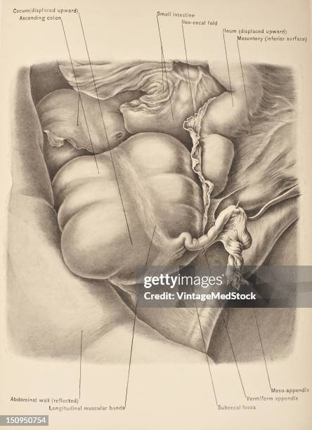 The subcecal fossa, as its name implies, is immediately under the cecum, so that this portion of the bowel must be raised in order to obtain to view...