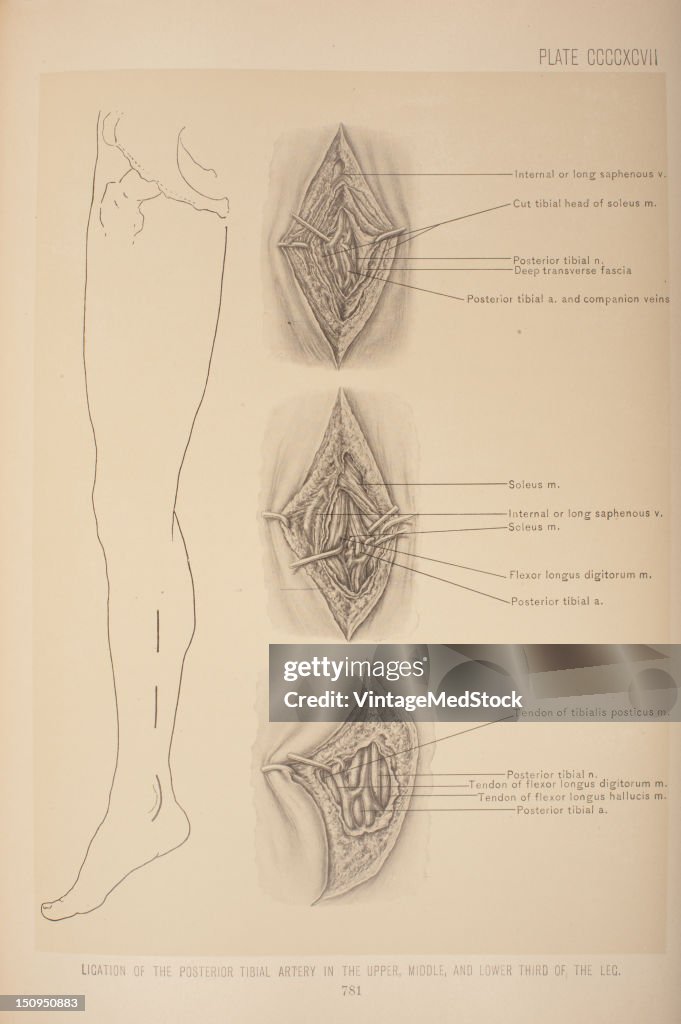 Ligation Of The Posterior Tibial Artery In The Upper, Middle, & Lower Third Of The Leg