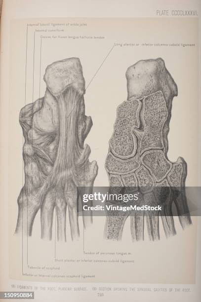 Plantar ligament refers to ligaments of the sole of the foot, 1903. From 'Surgical Anatomy: The Treatise of the Human Anatomy and Its Applications to...