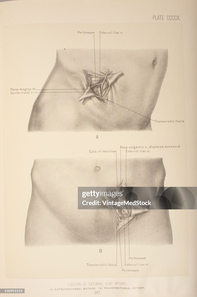 Ligation Of External Iliac Artery