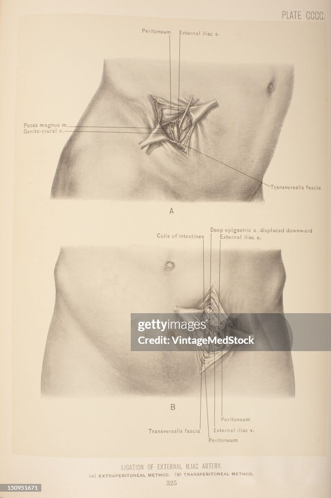 Ligation Of External Iliac Artery