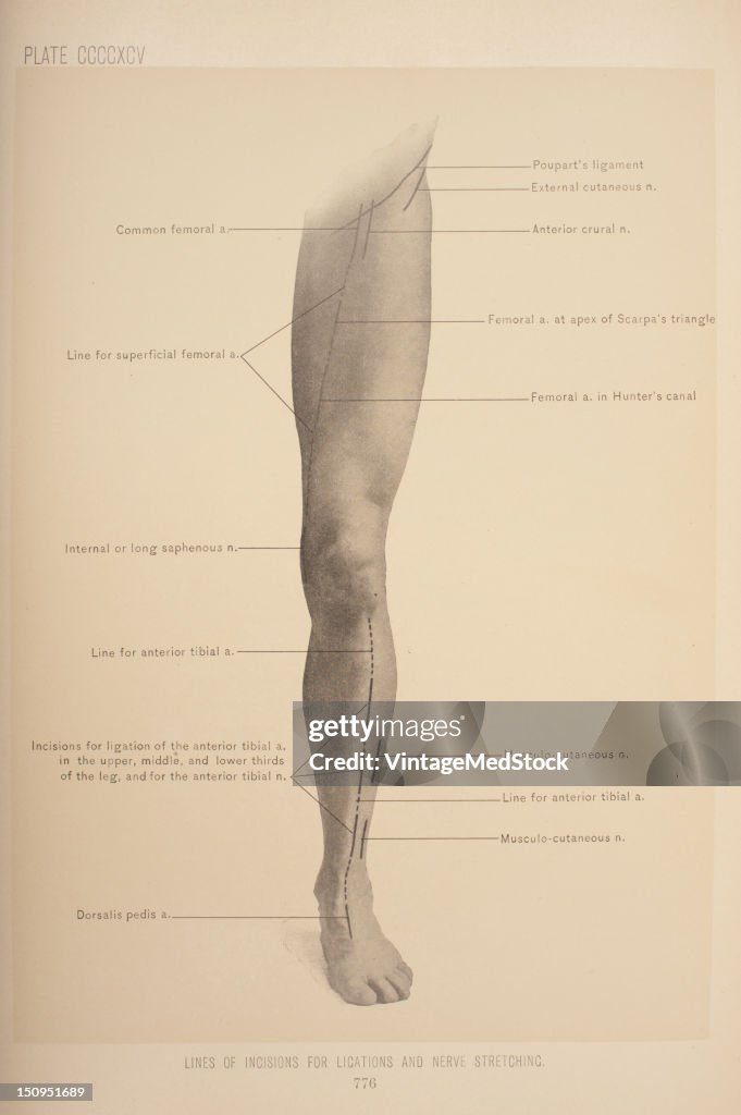 Lines Of Incision For Ligations & Nerve Stretching