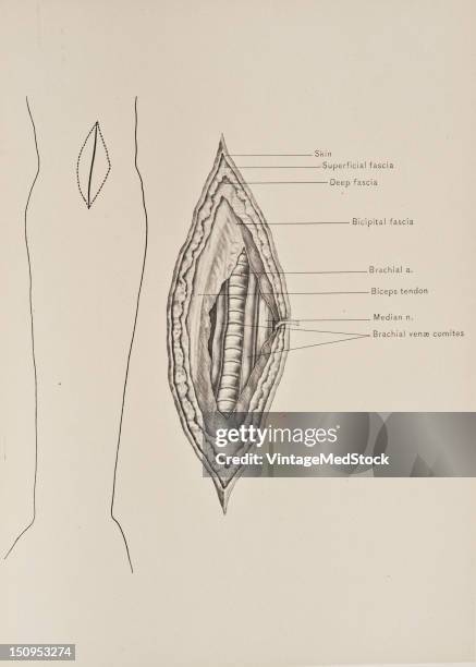 The brachial artery is the continuation of the axillary artery, and begins a the lower edge of the tendon of the teres major muscle, 1899. From 'The...