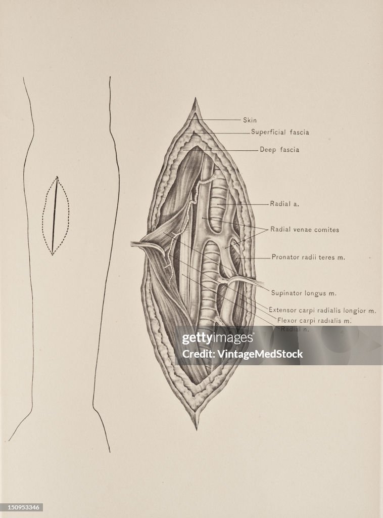 Radial Artery & Nerve At Middle Of Forearm