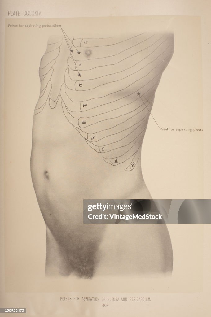 Points For Aspiration Of Pleura An Pericardium
