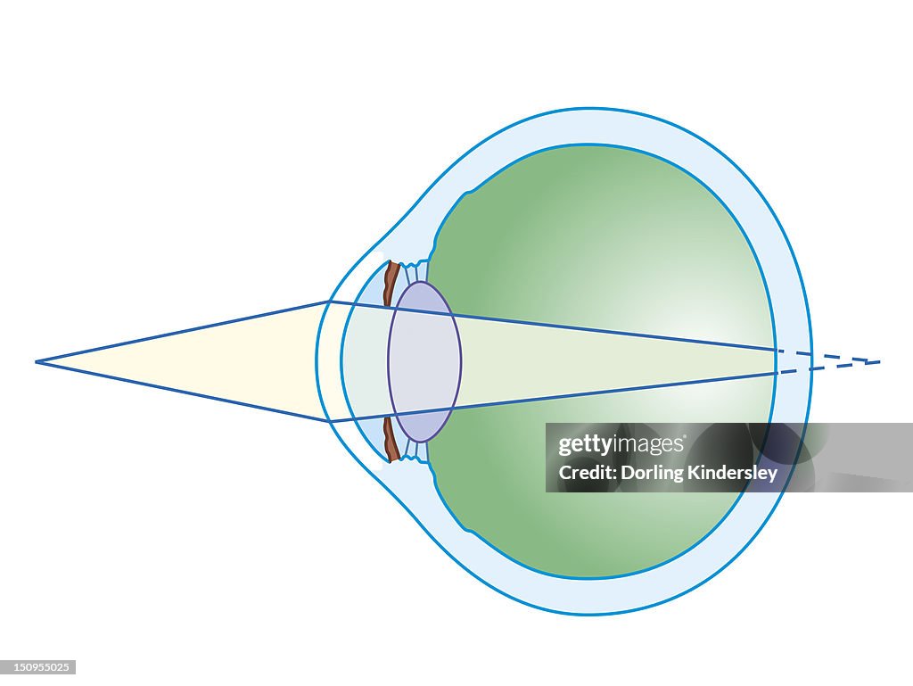 Cross section biomedical illustration of hypermetropia