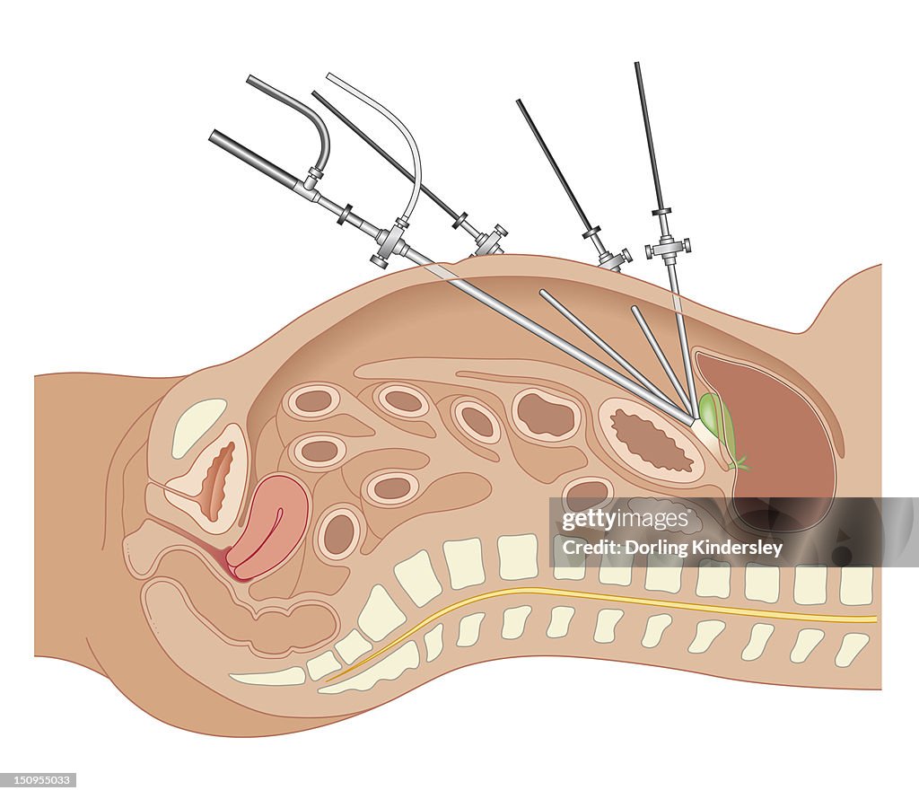 Cross section biomedical illustration of endoscope and tubes inserted in abdomen of adult female during Laparoscopic Surgery