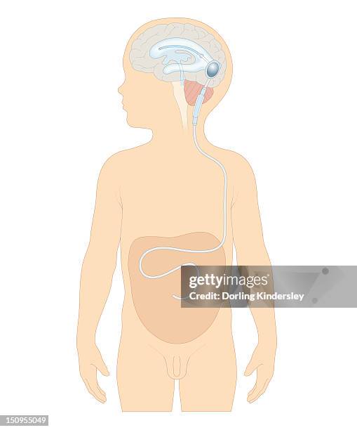 cross section biomedical illustration of cerebral shunt with valve inserted in brain of boy to remove excess cerebrospinal fluid with tube to carry into stomach - hydrocephalus stock illustrations