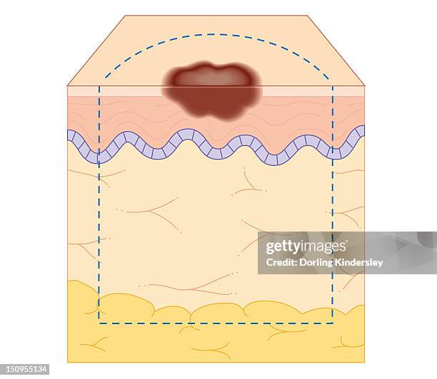 cross section biomedical illustration of site of skin biopsy - biopsy stock illustrations