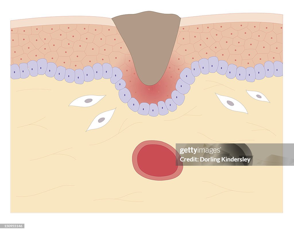 Cross section biomedical illustration of skin repair with fibroblast forming plug within Thrombus (blood clot) which contracts and plug shrinks and new skin tissue forms underneath
