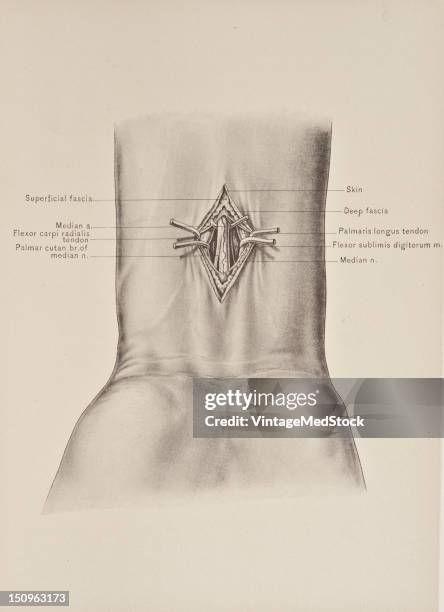The median nerve may be stretched at any part of its course in the arm, 1899. From 'The Treatise of the Human Anatomy and Its Applications to the...