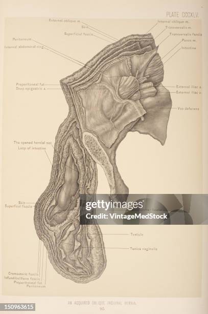 An oblique inguinal hernia is a hernia which passes through the internal abdominal ring follows the spermatic cord in an oblique direction, 1903....