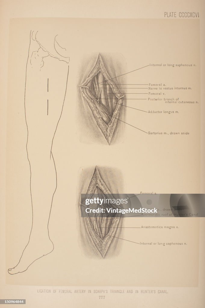 Ligation Of Femoral Artery In Scarpa's Triangle & In Hunter's Canal