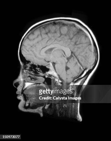 Mri Scan Of Human Head High-Res Vector Graphic - Getty Images