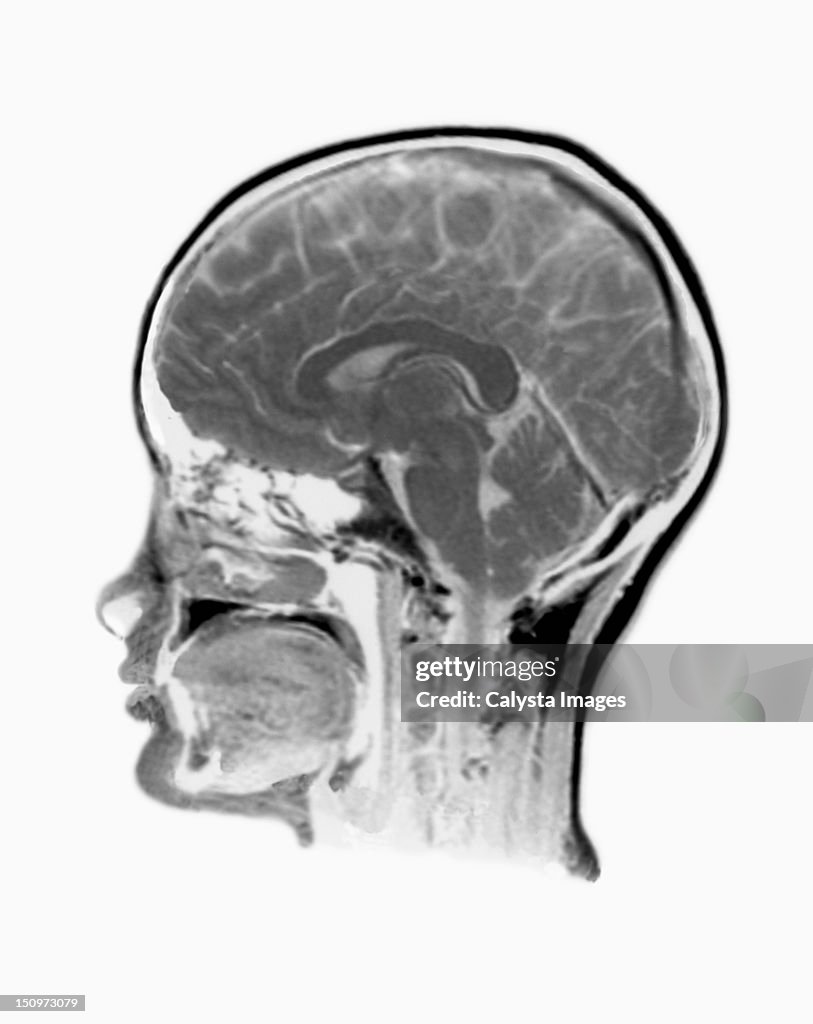 MRI Scan of human head