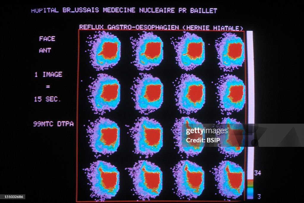 Gastroesophageal Reflux