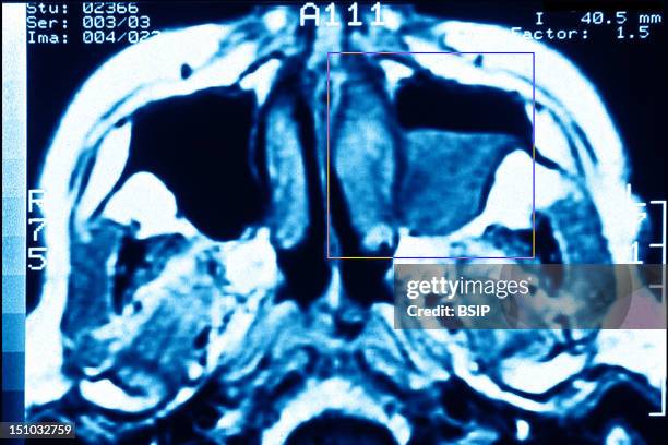Mri Scan Sinus Machine 1,766 Sinus Infection Stock Photos, High-Res Pictures, and Images ...