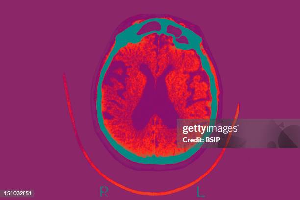 Scan Of The Brain Of A Patient Affected By Alzheimer's Disease Axial Section. Intersections Of Lateral Ventricles Are Dilated.